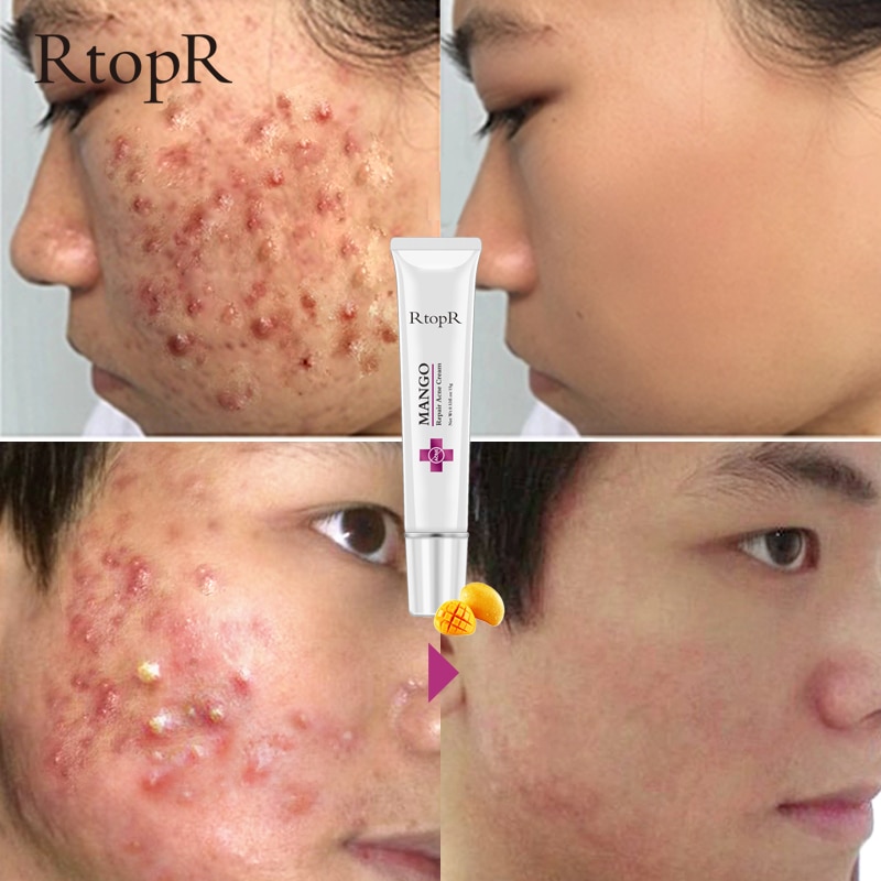 RtopR Mango Repair Acne Cream Wajah Penghilang Jerawat ...